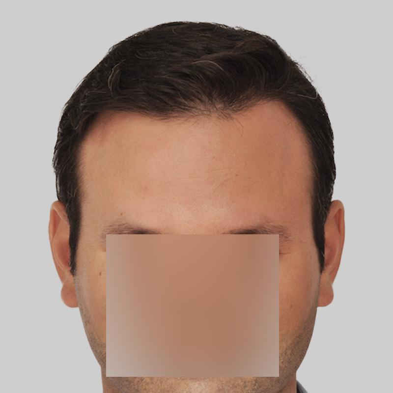 Hair Transplant 2004 grafts FUE