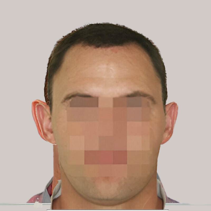 Patient UJT before & after FUE results comparison front