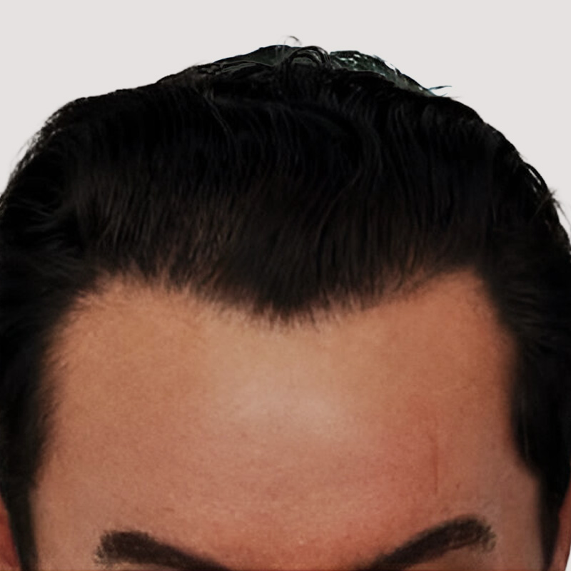 Hair Transplant 2055 grafts FUE