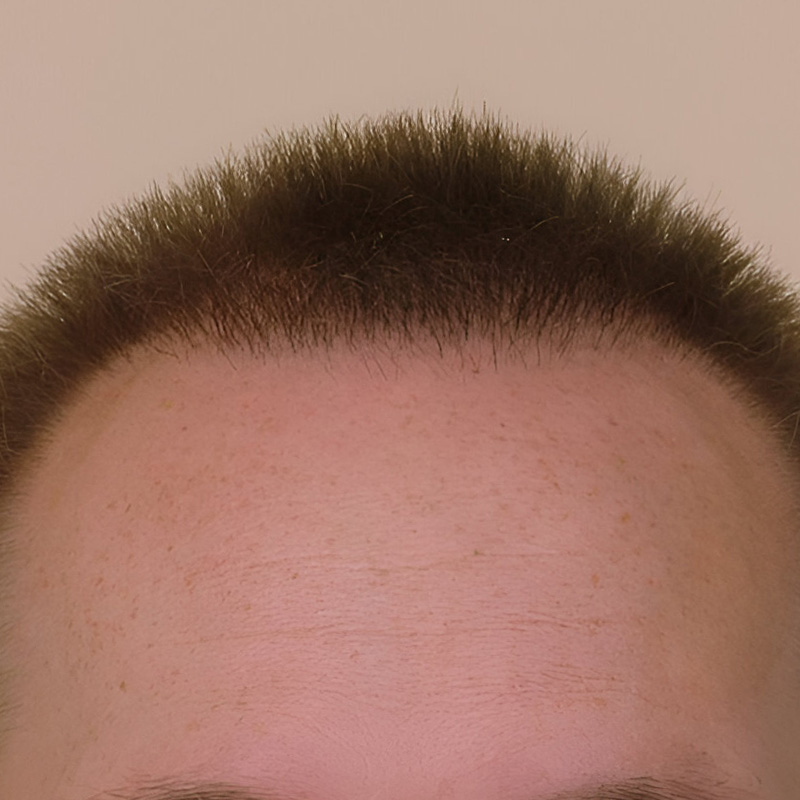 Hair Transplant 2040 grafts FUE