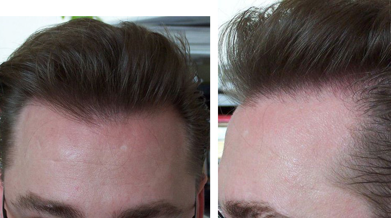 After Hairline