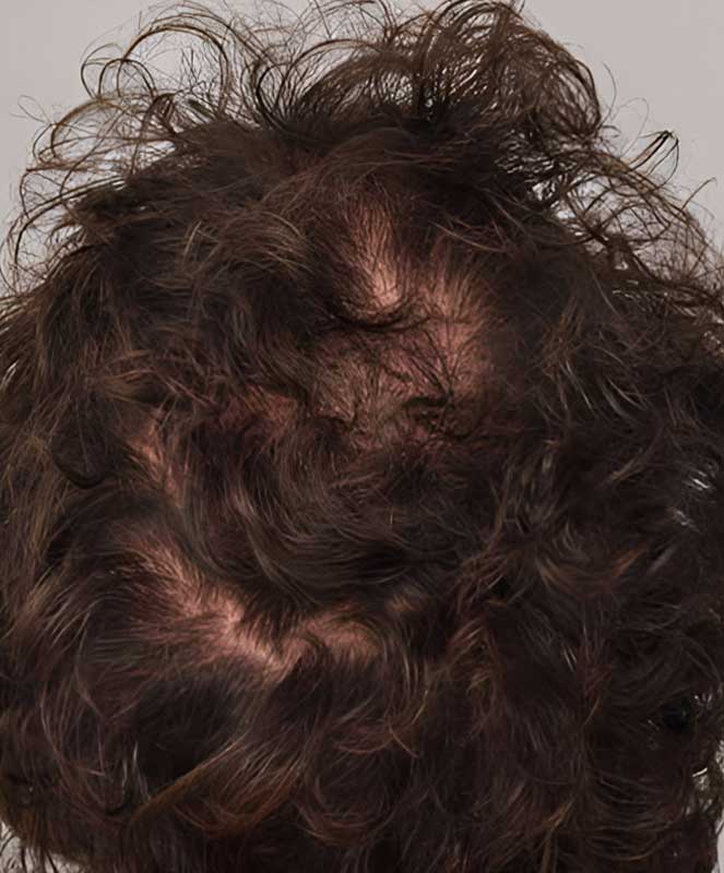 Hair Transplant 515 grafts FUE