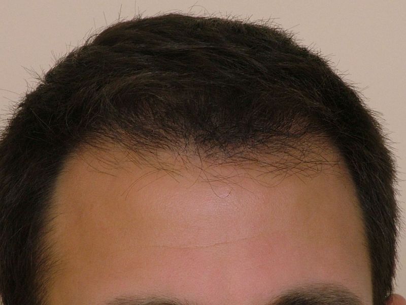 Hair Transplant 1101 grafts FUE