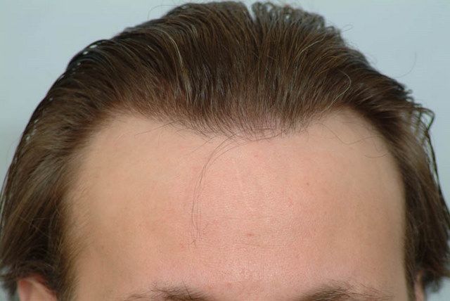 Hair Transplant 4800 grafts FUE