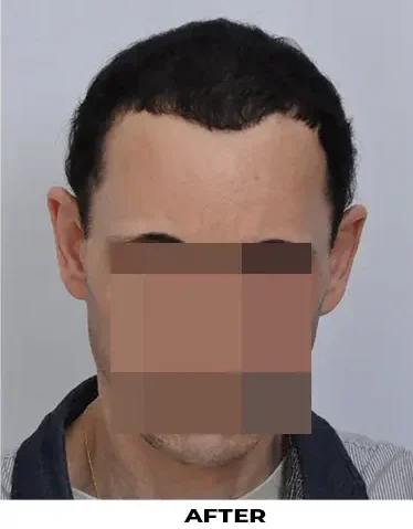 Hair Transplant 2501 grafts FUE