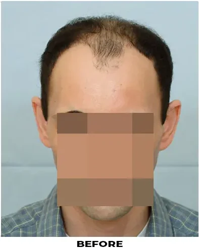 Hair Transplant 2501 grafts FUE