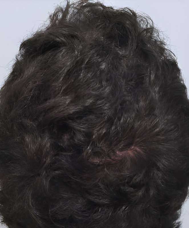 Hair Transplant 515 grafts FUE