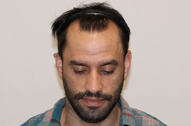 Hair Transplant 2930 grafts FUE featured