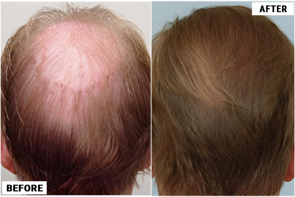 Before and after back view