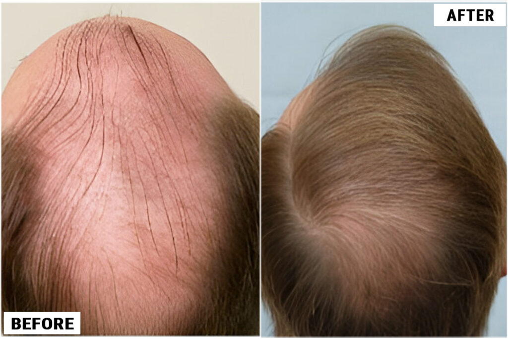 before and after crown