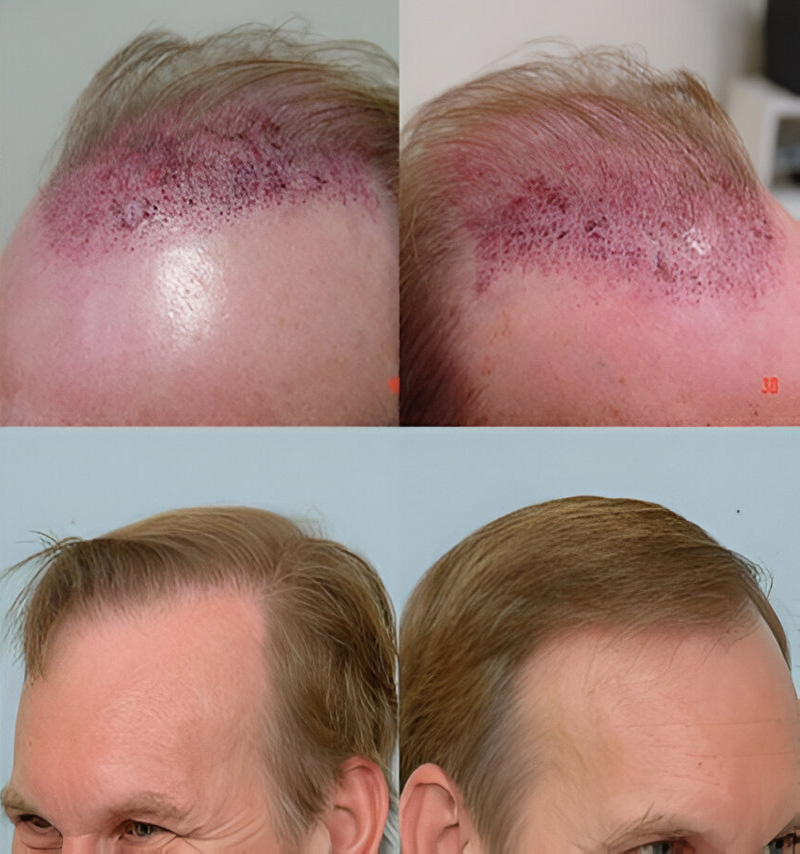 before and after side view