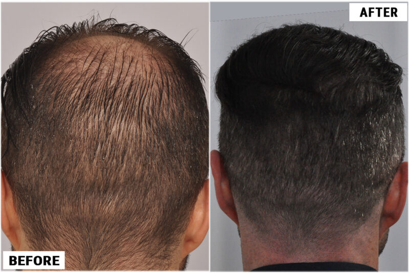 Hair transplant 3957 grafts FUE back crown