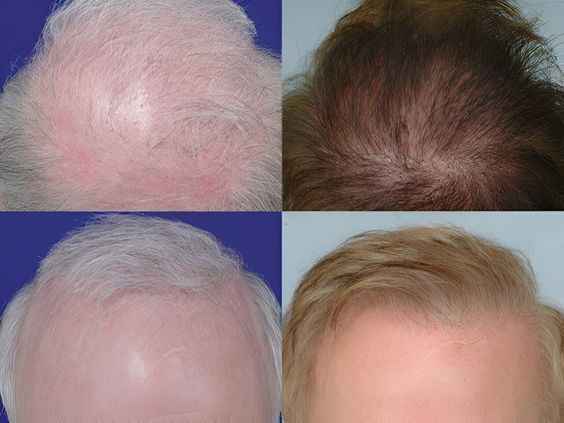 Before and after crown