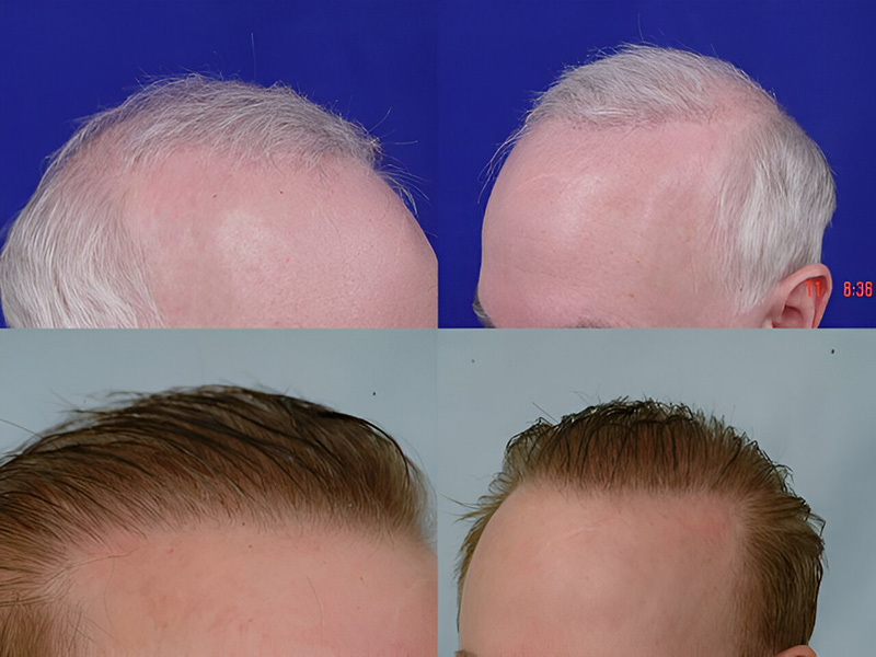 Before and after side view