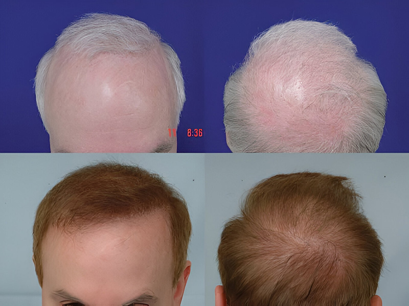 Before and after collage hairline and crown