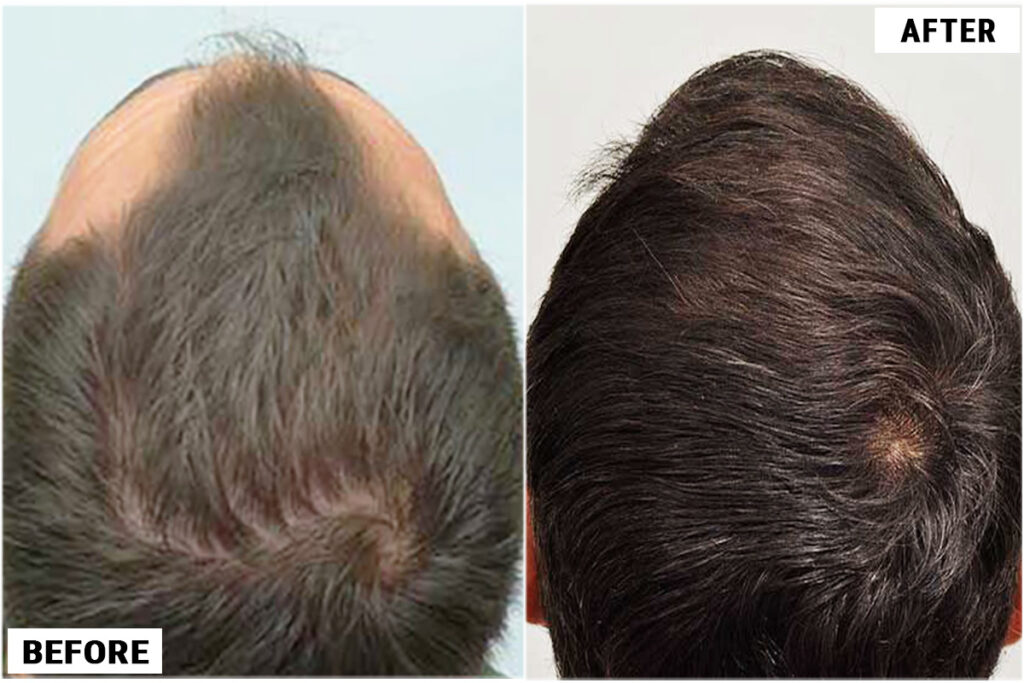 before and after crown