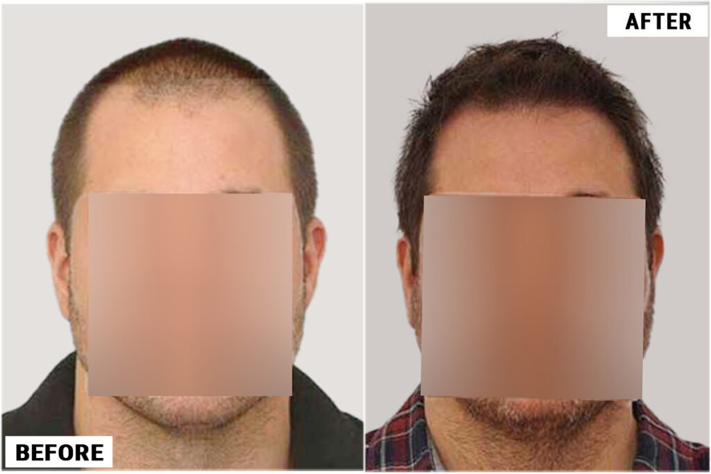 Before and after front