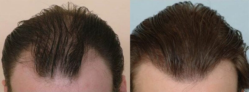Hair Transplant 4800 grafts FUE front view