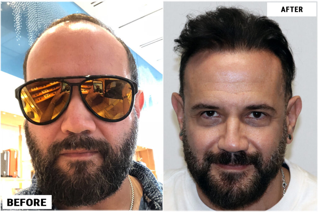 Hair transplant 4200 grafts FUE  front #2