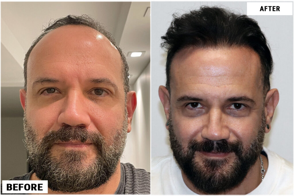 Hair transplant 4200 grafts FUE front