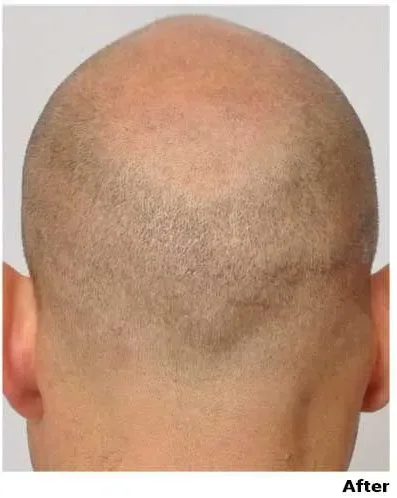Repair & SMP 447 grafts