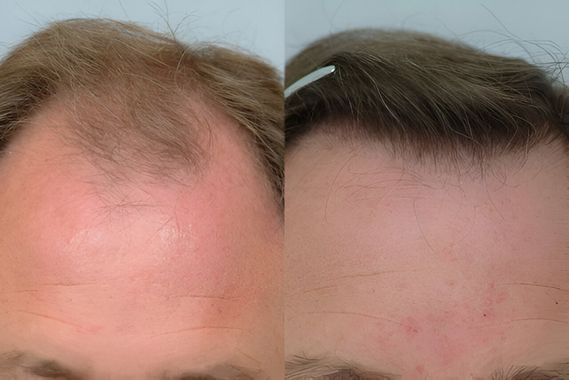 Before and after hairline