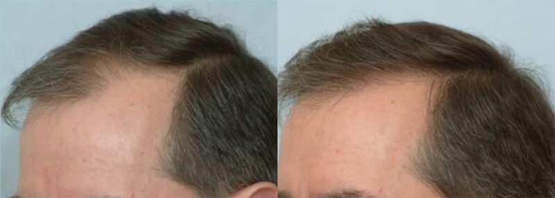 Hair Transplant 1400 grafts FUE - Left