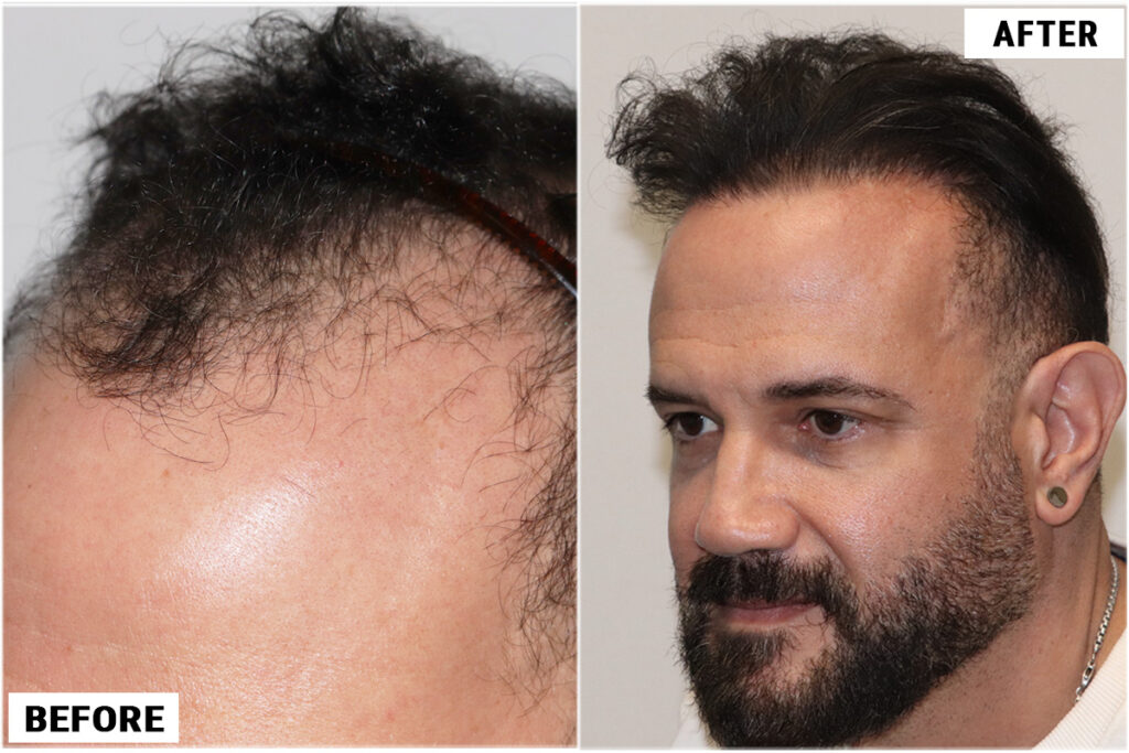 Hair transplant 4200 grafts FUE left