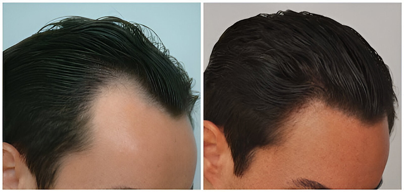 Before and after left view