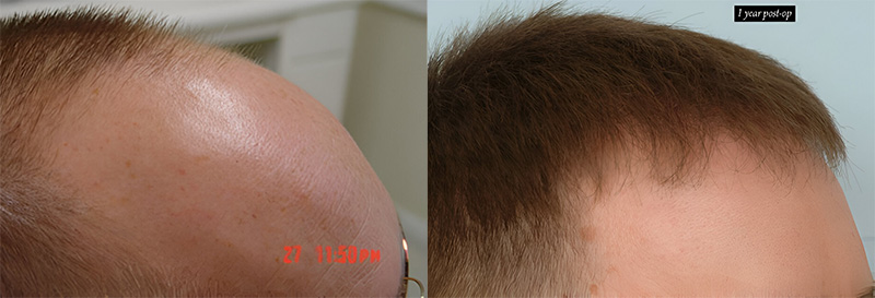 before and after right side