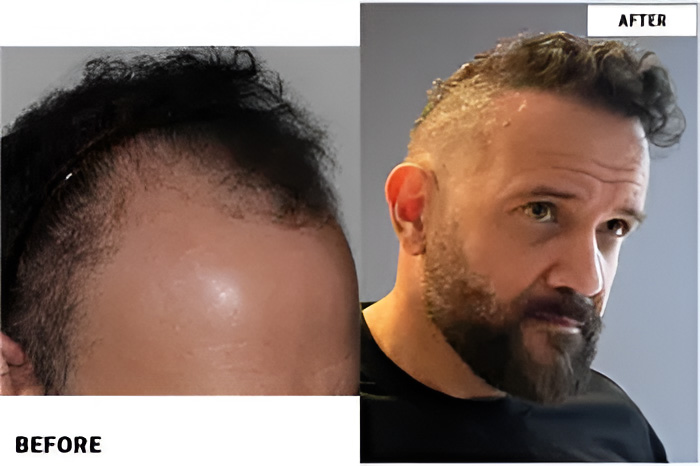 Hair transplant 4200 grafts FUE right