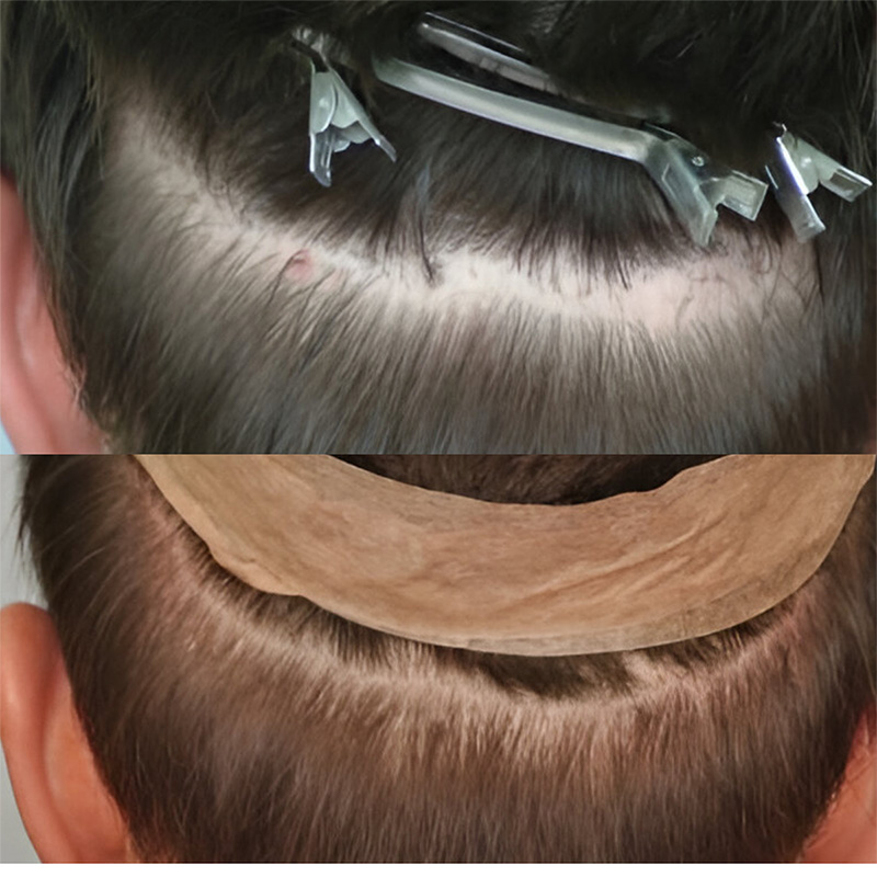 Before Scar Repair 482 grafts FUE - featured image