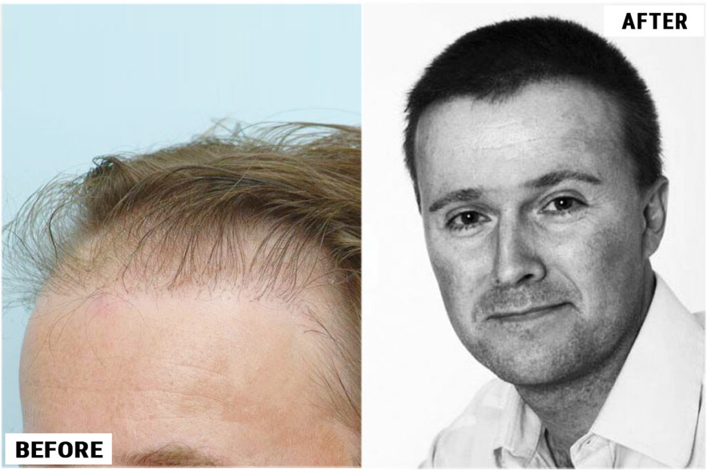 Before FUE results side