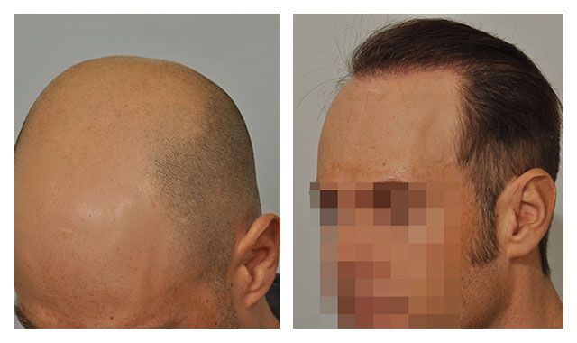 Before and after FUE left