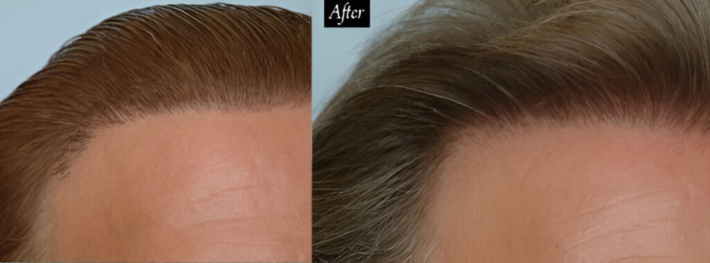 Before and after hairline