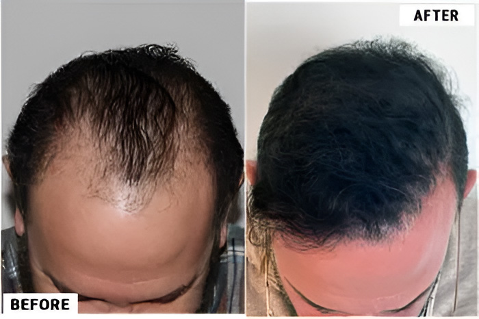 Hair transplant 4200 grafts FUE top