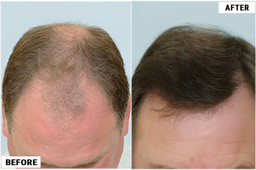 Before and after top