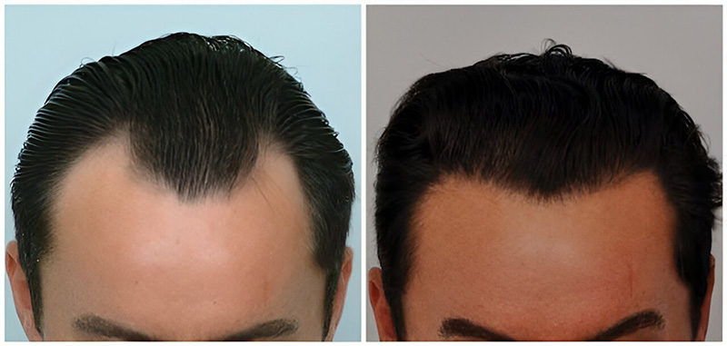 Before and after hairline