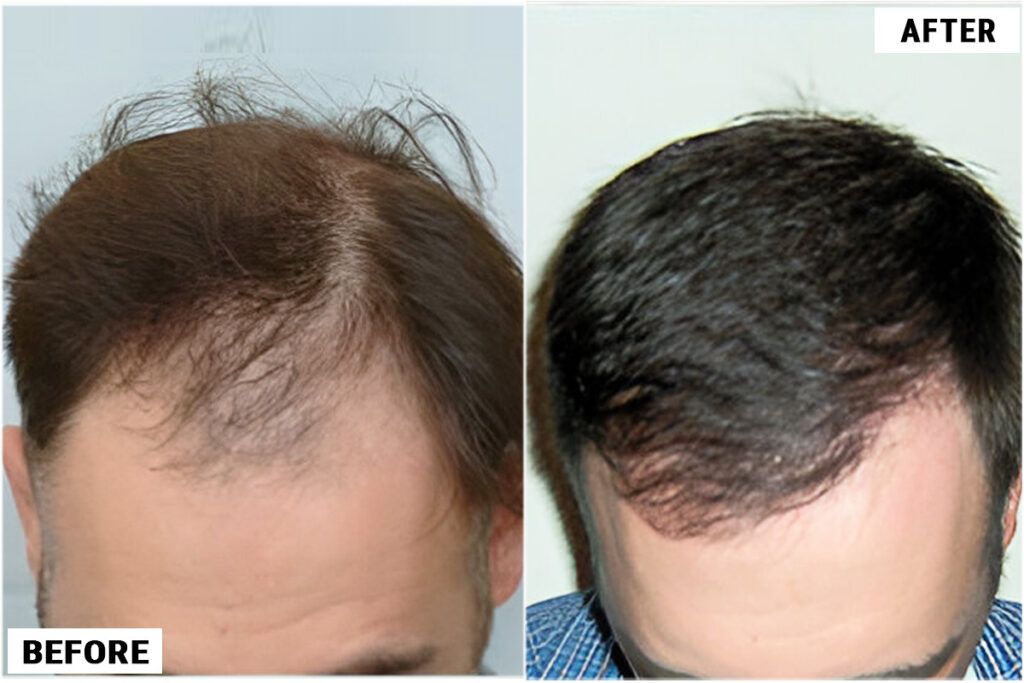 Before and after top 1