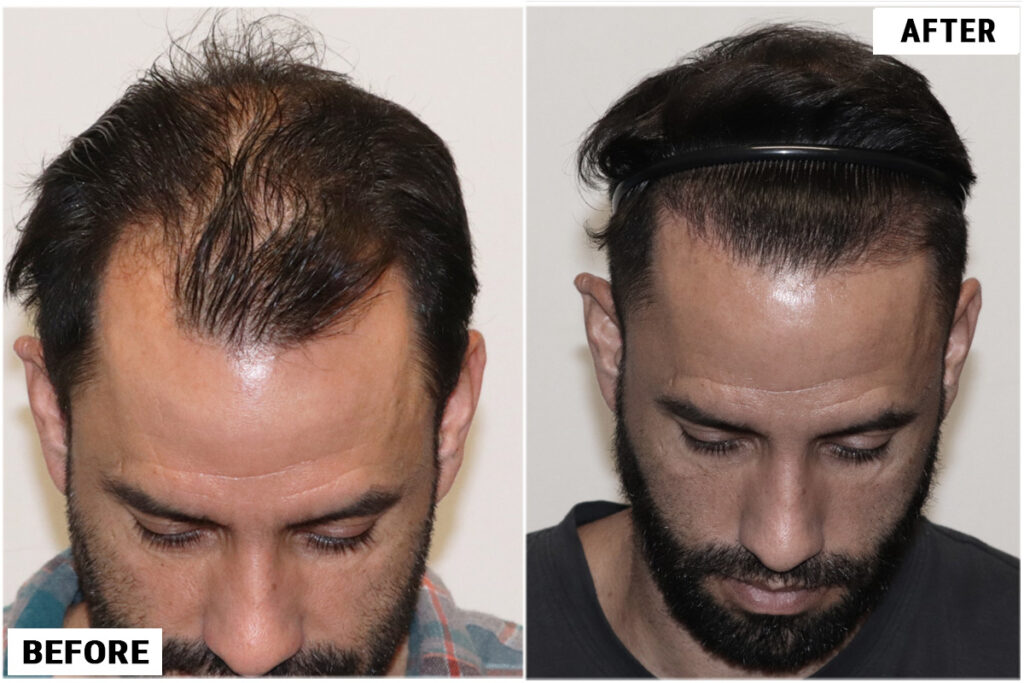 Before and after FUE top 2