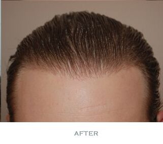 Hair Transplant 1700 grafts FUE