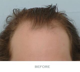Hair Transplant 1700 grafts FUE