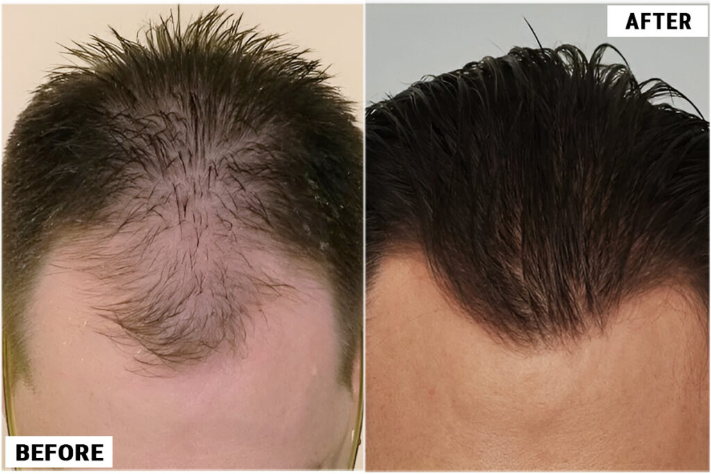FUE 1845 grafts before & after featured
