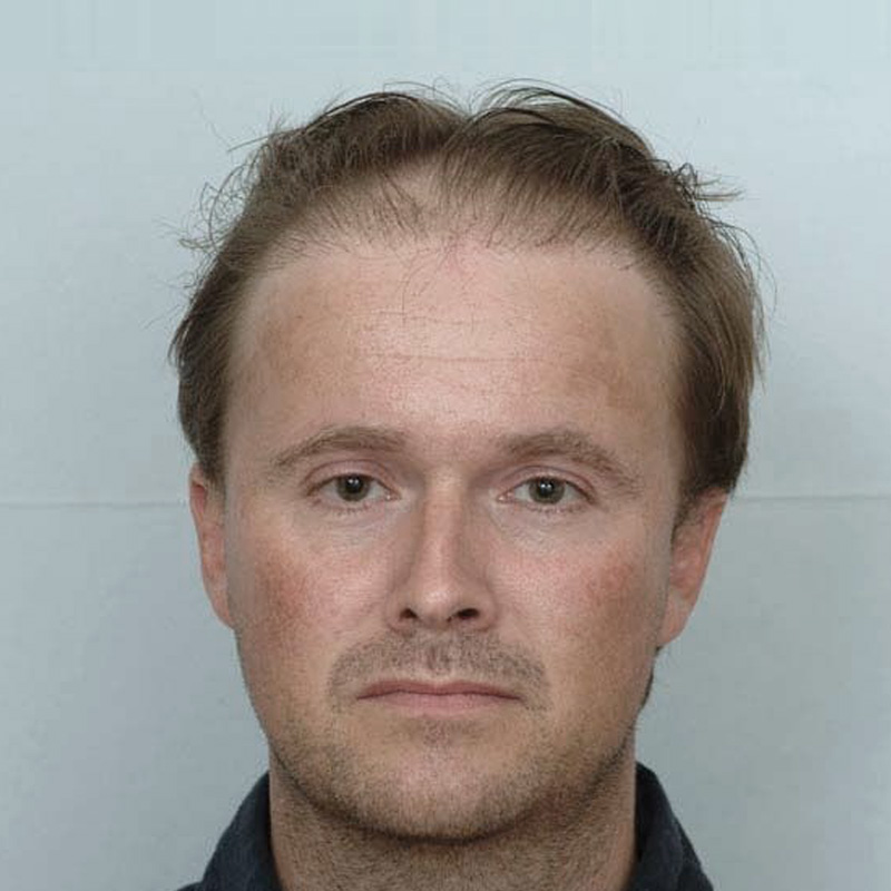 Hair Transplant 1654 grafts FUE