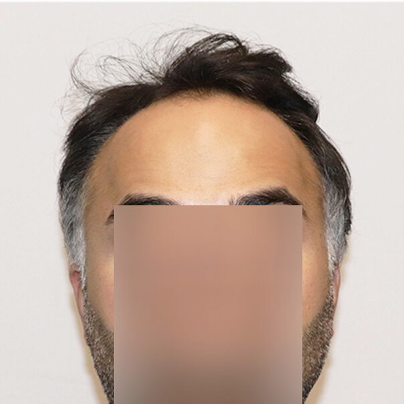 Hair Transplant 3178 grafts FUE