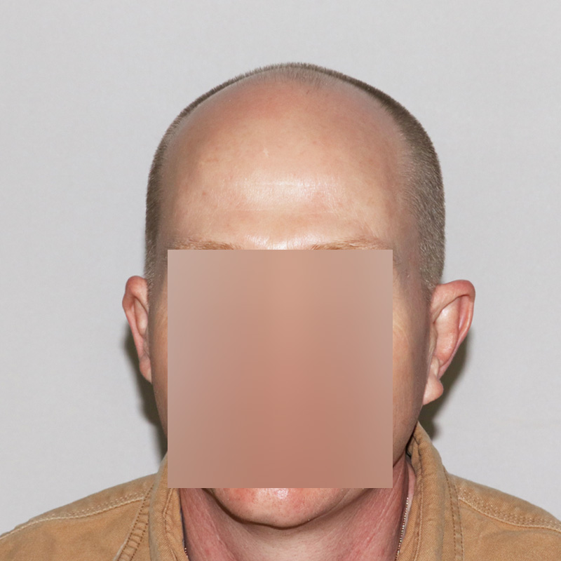 Hair Transplant 3123 grafts FUE