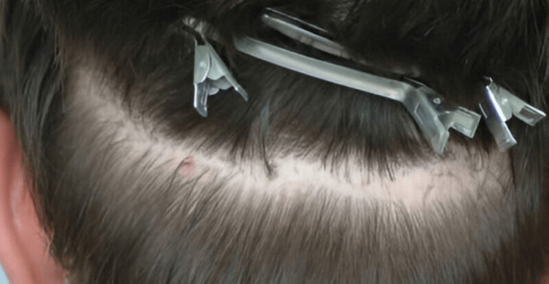 Before Scar Repair 482 grafts FUE