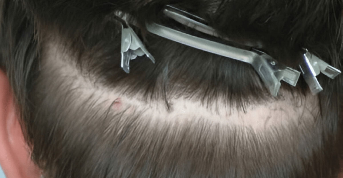 Before Scar Repair 482 grafts FUE - featured image