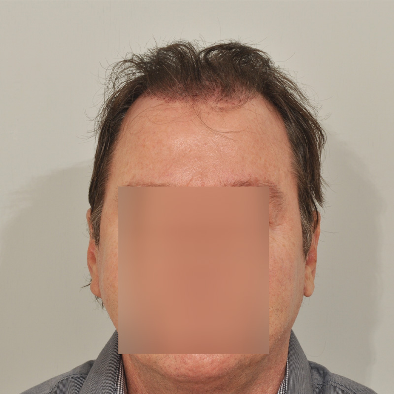 Hair Transplant 2882 grafts FUE