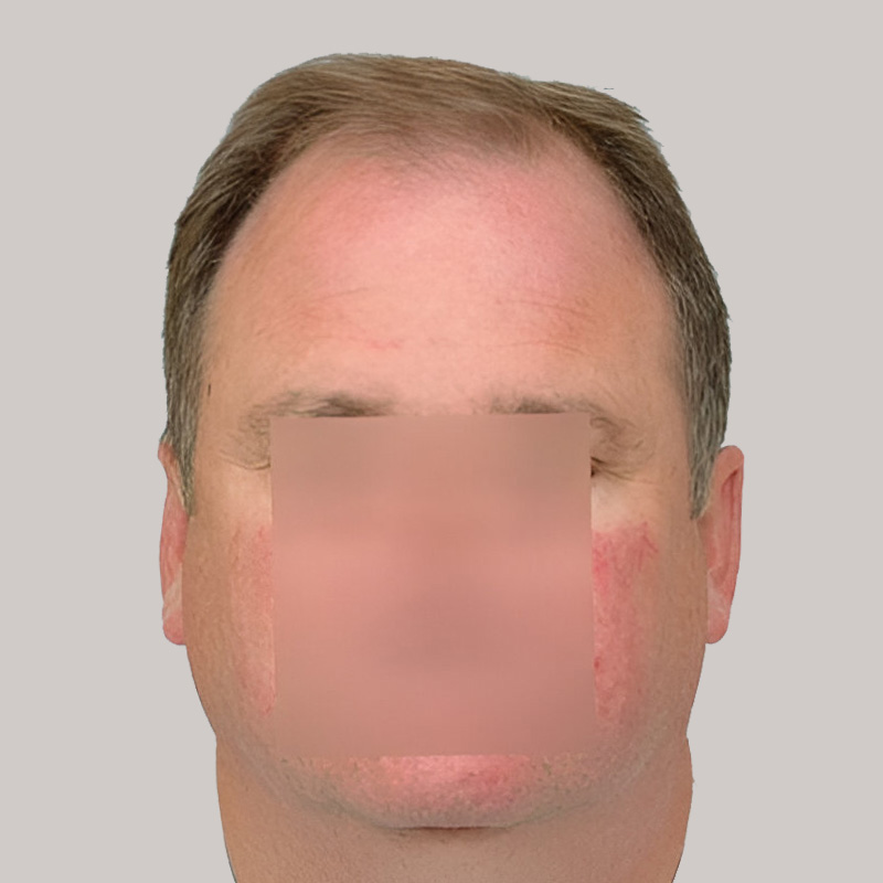 Hair Transplant 3129 grafts FUE